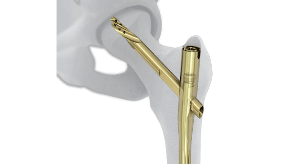 Tratamento de Fraturas | Cirurgias | Dr. Roni Serra