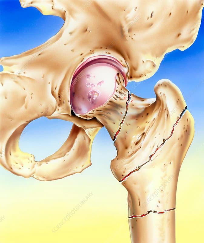 Tratamento de Fraturas | Cirurgias | Dr. Roni Serra