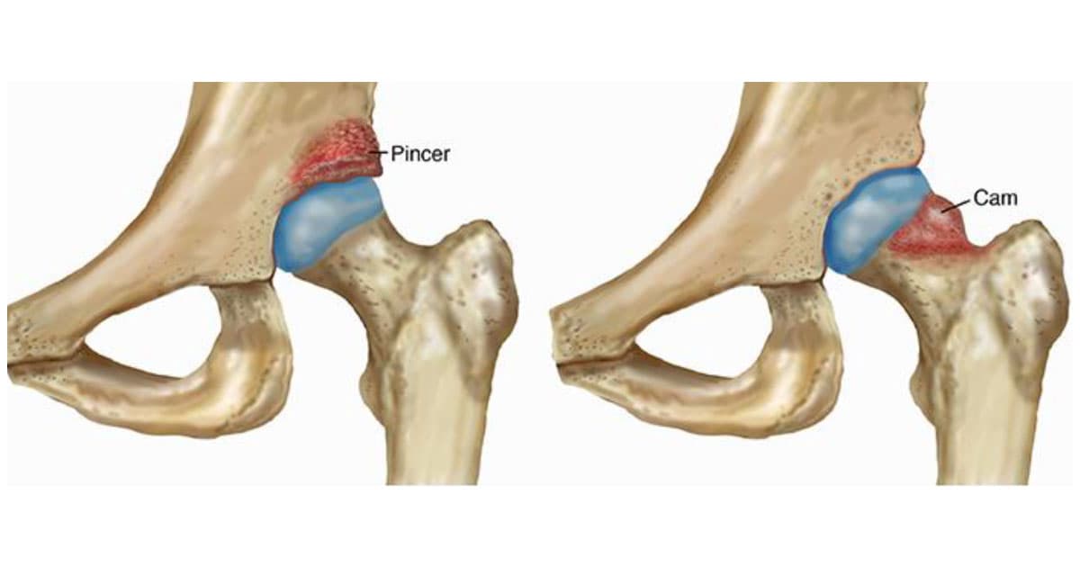 Impacto Femoroacetabular