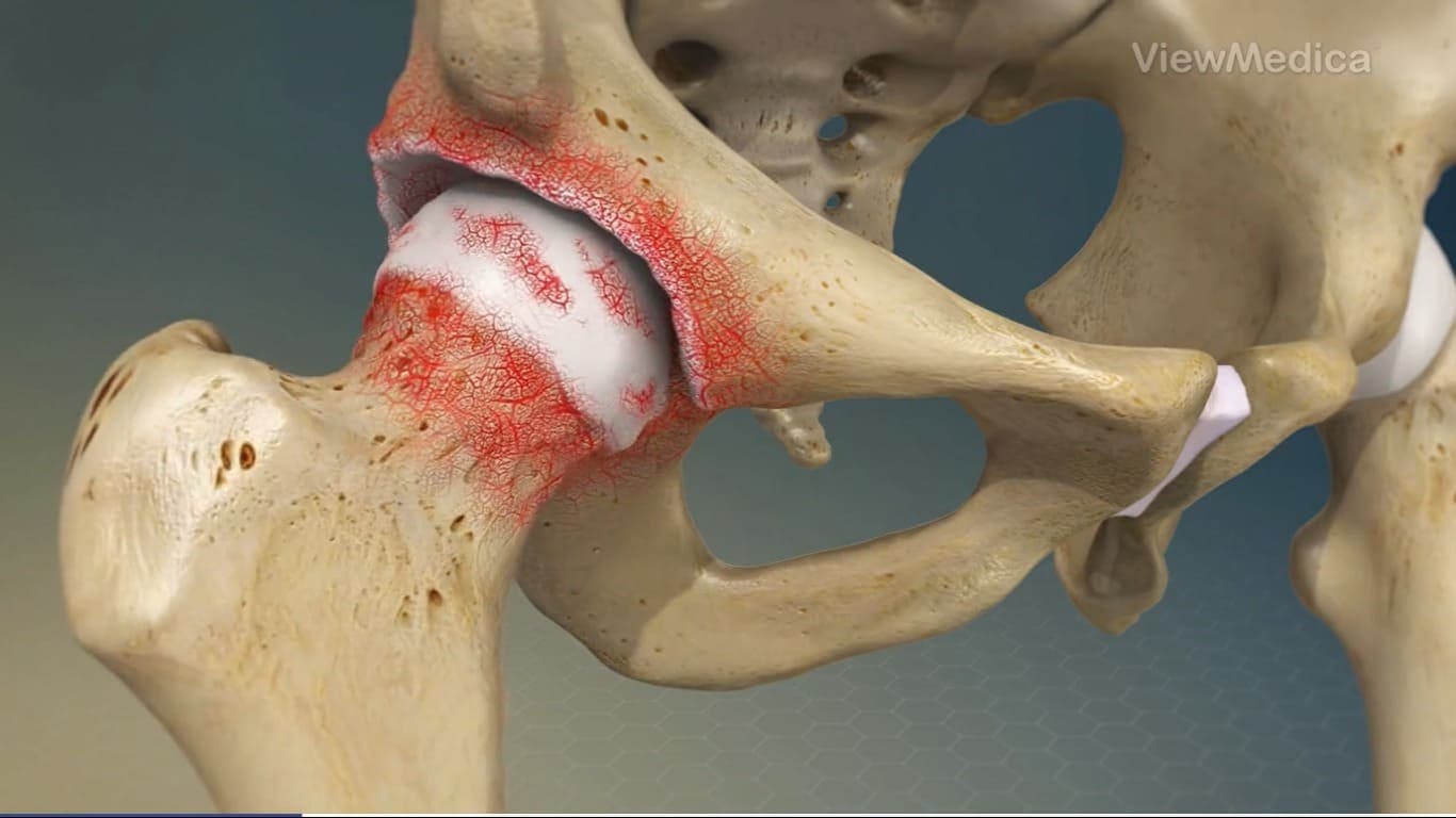 Osteoartrose do Quadril