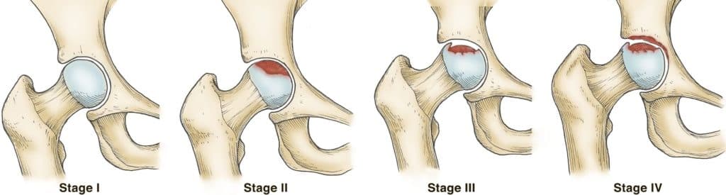 Osteonecrose da Cabeça Femoral | Patologias | Dr. Roni Serra